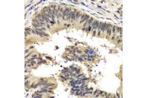 Immunohistochemistry of paraffin-embedded human colon carcinoma using RBBP5 antibody at dilution of 1:100 (x40 lens). (RBBP5 Antikörper)