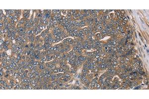Immunohistochemistry of paraffin-embedded Human cervical cancer using HSD17B12 Polyclonal Antibody at dilution of 1:30 (HSD17B12 Antikörper)