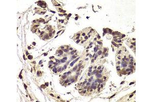 Immunohistochemistry of paraffin-embedded Human breast cancer using INTS6 Polyclonal Antibody at dilution of 1:100 (40x lens). (INTS6 Antikörper)
