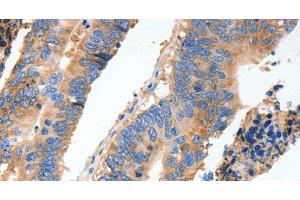 Immunohistochemistry of paraffin-embedded Human colon cancer tissue using MUC6 Polyclonal Antibody at dilution 1:40 (MUC6 Antikörper)