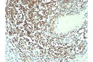 Formalin-fixed, paraffin-embedded human Bladder carcinoma stained with Nucleolin MAb (364-5 + NCL/902). (Nucleolin Antikörper)