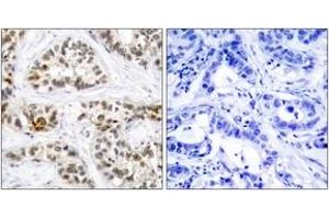 Immunohistochemistry analysis of paraffin-embedded human breast carcinoma, using RelB (Phospho-Ser552) Antibody. (RELB Antikörper  (pSer573))