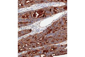Immunohistochemical analysis of paraffin-embedded Human colon carcinoma tissue using C performed on the Leica® BOND RXm. (CEA Antikörper  (AA 400-429))