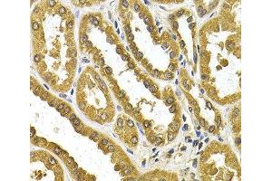 Immunohistochemistry of paraffin-embedded Human kidney cancer using UGT1A4 Polyclonal Antibody at dilution of 1:200 (40x lens).