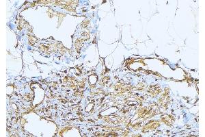 ABIN6275232 at 1/100 staining Human lung cancer tissue by IHC-P. (MRPS2 Antikörper  (C-Term))