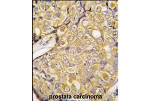 Formalin-fixed and paraffin-embedded human prostata carcinoma tissue reacted with , which was peroxidase-conjugated to the secondary antibody, followed by DAB staining. (TRPM8 Antikörper  (AA 521-552))