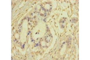 Immunohistochemistry of paraffin-embedded human pancreatic cancer using ABIN7170681 at dilution of 1:100 (SRPK3 Antikörper  (AA 1-300))
