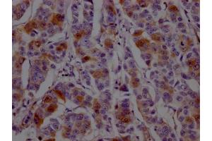 IHC image of ABIN7127454 diluted at 1:100 and staining in paraffin-embedded human breast cancer performed on a Leica BondTM system. (Rekombinanter Dihydrofolate Reductase Antikörper)
