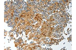 The image on the left is immunohistochemistry of paraffin-embedded Human tonsil tissue using ABIN7130695(PRCP Antibody) at dilution 1/20, on the right is treated with fusion protein. (PRCP Antikörper)