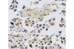 Immunohistochemistry of paraffin-embedded Human lung cancer using C12orf10 Polyclonal Antibody at dilution of 1:100 (40x lens). (C12orf10 Antikörper)