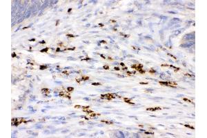 Anti- Lysozyme Picoband antibody, IHC(P) IHC(P): Human Intestinal Cancer Tissue