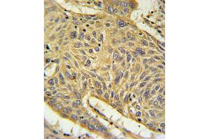 AGER Antibody IHC analysis in formalin fixed and paraffin embedded human lung carcinoma followed by peroxidase conjugation of the secondary antibody and DAB staining.