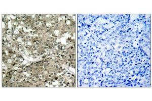 Immunohistochemical analysis of paraffin-embedded human breast carcinoma tissue using c-Abl (Ab-412) antibody (E021156). (ABL1 Antikörper)