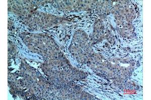 Immunohistochemistry (IHC) analysis of paraffin-embedded Human Breast Cancer, antibody was diluted at 1:100. (PLA2G4A Antikörper  (N-Term))