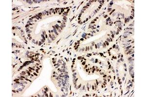 IHC-P: IRF1 antibody testing of human intestinal cancer tissue (IRF1 Antikörper  (Middle Region))