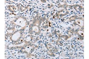 The image on the left is immunohistochemistry of paraffin-embedded Human gastic cancer tissue using ABIN7189583(ABCB9 Antibody) at dilution 1/15, on the right is treated with synthetic peptide. (ABCB9 Antikörper)