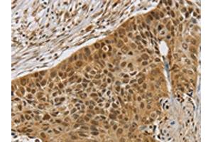 The image on the left is immunohistochemistry of paraffin-embedded Human esophagus cancer tissue using ABIN7192565(SMC6 Antibody) at dilution 1/30, on the right is treated with synthetic peptide. (SMC6 Antikörper)