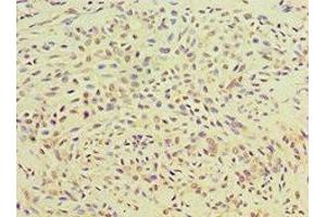Immunohistochemistry of paraffin-embedded human breast cancer using ABIN7166414 at dilution of 1:100 (Transglutaminase 2 Antikörper  (AA 438-687))