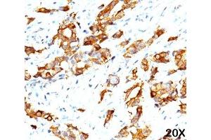 IHC testing of breast carcinoma (20X) stained with HSP27 antibody (G3. (HSP27 Antikörper)