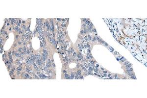 Immunohistochemistry of paraffin-embedded Human colorectal cancer tissue using UBR4 Polyclonal Antibody at dilution of 1:55(x200) (UBR4 Antikörper)