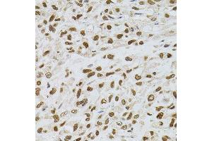 Immunohistochemistry of paraffin-embedded human lung cancer using TGM2 antibody. (Transglutaminase 2 Antikörper)