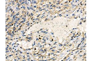 ABIN6262655 and ABIN6276467 at 1/100 staining Human ovarian cancer and adjacent normal tissues by IHC-P.