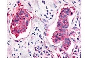 Anti-ELTD1 antibody IHC of human Breast, Carcinoma.