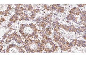 ABIN6272681 at 1/100 staining Human liver cancer tissue by IHC-P. (CCR4 Antikörper  (N-Term))