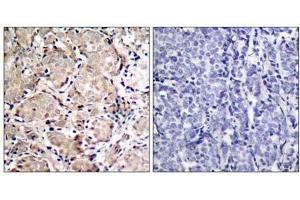 Immunohistochemical analysis of paraffin-embedded human breast carcinoma tissue using FKHR (phospho- Ser319) antibody (E011136). (FOXO1 Antikörper  (pSer319))