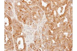 IHC-P Image Immunohistochemical analysis of paraffin-embedded N87 xenograft, using SLC25A13, antibody at 1:500 dilution. (slc25a13 Antikörper)