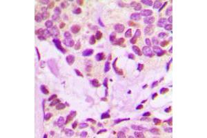 Immunohistochemical analysis of IRX3 staining in human breast cancer formalin fixed paraffin embedded tissue section. (IRX3 Antikörper  (Center))