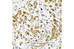 Immunohistochemistry of paraffin-embedded human gastric cancer using TAPBP Antibody. (TAPBP Antikörper)