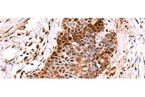 Immunohistochemistry of paraffin-embedded Human esophagus cancer tissue using POLD2 Polyclonal Antibody at dilution of 1:60(x200)