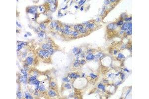 Immunohistochemistry of paraffin-embedded Human liver cancer using PNLIP Polyclonal Antibody at dilution of 1:100 (40x lens). (PNLIP Antikörper)