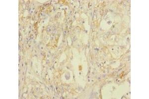 Immunohistochemistry of paraffin-embedded human lung cancer using ABIN7170802 at dilution of 1:100 (STOML2 Antikörper  (AA 29-356))