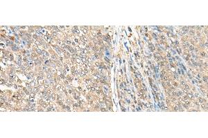 Immunohistochemistry of paraffin-embedded Human liver cancer tissue using ASS1 Polyclonal Antibody at dilution of 1:35(x200) (ASS1 Antikörper)