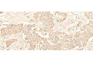 Immunohistochemistry of paraffin-embedded Human liver cancer tissue using DIMT1 Polyclonal Antibody at dilution of 1:30(x200) (DIMT1 Antikörper)