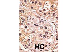 Formalin-fixed and paraffin-embedded human hepatocellular carcinoma tissue reacted with GDF9 polyclonal antibody  , which was peroxidase-conjugated to the secondary antibody, followed by AEC staining. (GDF9 Antikörper  (N-Term))