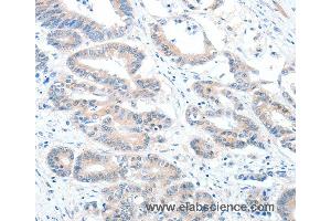 Immunohistochemistry of Human colon cancer using ALDH1A2 Polyclonal Antibody at dilution of 1:60 (ALDH1A2 Antikörper)
