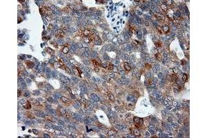 Immunohistochemical staining of paraffin-embedded Adenocarcinoma of colon tissue using anti-SIL1 mouse monoclonal antibody. (SIL1 Antikörper)