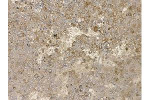 ABIN6255046 and ABIN6267160 at 1/100 staining human melanoma by IHC-P.