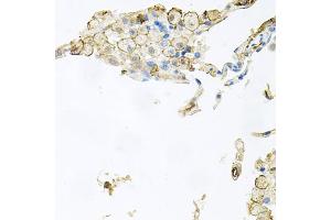 Immunohistochemistry of paraffin-embedded human lung injury using AIF1 antibody (ABIN5970719) at dilution of 1/100 (40x lens). (Iba1 Antikörper)