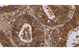 Immunohistochemistry of paraffin-embedded Human colon cancer tissue using WDR83 Polyclonal Antibody at dilution 1:60 (MORG1 Antikörper)