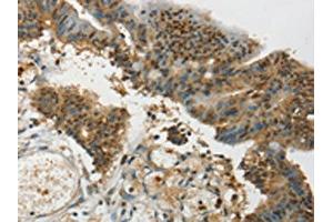 The image on the left is immunohistochemistry of paraffin-embedded Human colon cancer tissue using ABIN7192709(SYCP1 Antibody) at dilution 1/35, on the right is treated with synthetic peptide. (SYCP1 Antikörper)
