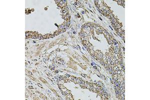 Immunohistochemistry of paraffin-embedded human prostate using TMC1 antibody (ABIN5996250) at dilution of 1/100 (40x lens). (TMC1 Antikörper)