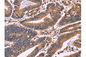 The image on the left is immunohistochemistry of paraffin-embedded Human colon cancer tissue using ABIN7130954(S100A13 Antibody) at dilution 1/40, on the right is treated with fusion protein. (S100A13 Antikörper)