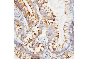 Anti-SPARC antibody, IHC(P) IHC(P): Human Intestinal Cancer Tissue
