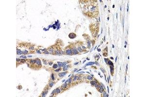 Immunohistochemistry of paraffin-embedded Human stomach cancer using FABP3 Polyclonal Antibody at dilution of 1:200 (40x lens). (FABP3 Antikörper)
