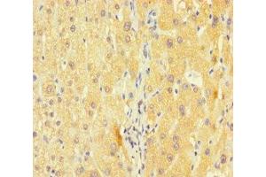 Immunohistochemistry of paraffin-embedded human liver cancer using ABIN7163953 at dilution of 1:100 (Kv1.6/KCNA6 Antikörper  (AA 1-171))