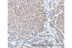 Immunohistochemistry of Human liver cancer using ADAM20 Polyclonal Antibody at dilution of 1:50